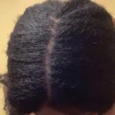 Vertex scalp